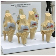 4-ių stadijų, osteoartrito paveikto, kelio modelių rinkinys