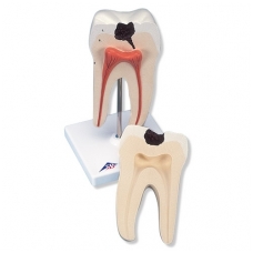 Apatinio krūminio danties su dviguba šaknimi ir įdubomis modelis, 2 dalys