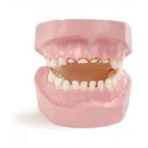Modelis „Kūdikių dantų ėduonis - maitinimo buteliuku pasekmė“