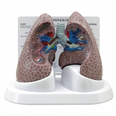 Modelių rinkinys „Plaučiai su patologijomis”