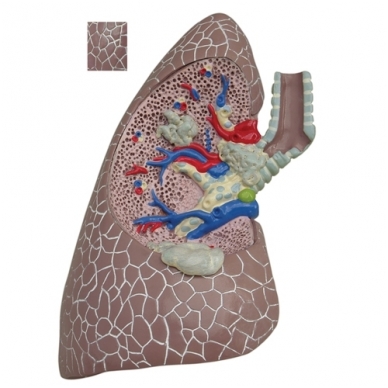 Modelių rinkinys „Plaučiai su patologijomis” 1