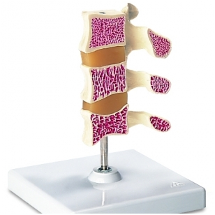 Osteoporozės modelis (3 slanksteliai)