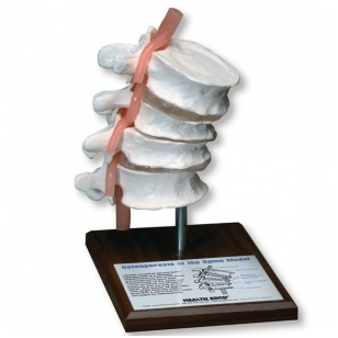 Osteoporozės stuburo modelis