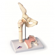 Šlaunikaulio lūžio ir klubikaulio osteoartrito modelis