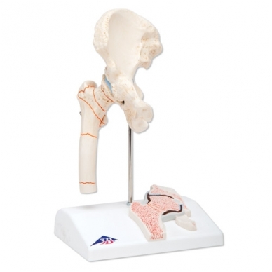 Šlaunikaulio lūžio ir klubikaulio osteoartrito modelis 1