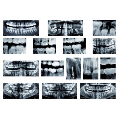Žmogaus dantų rentgeno nuotraukų rinkinys 3